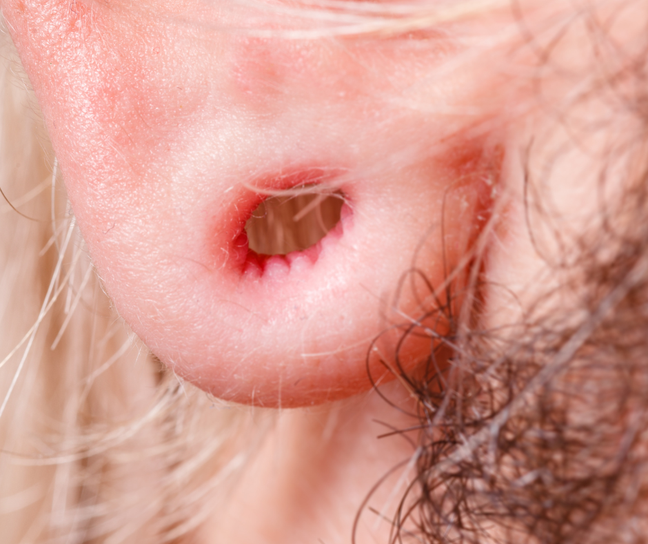 uitgescheurd oor stretcher oorlelcorrectie